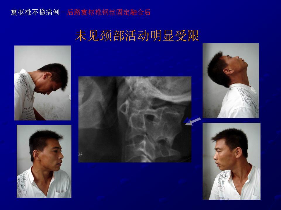 寰枢椎脱位后路固定手术成功 而且颈椎运动未受到明显影响