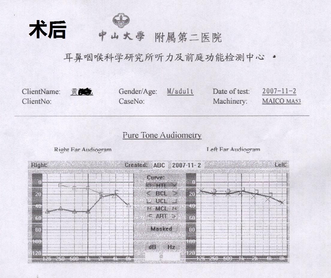 耳硬化症术前术后听力变化