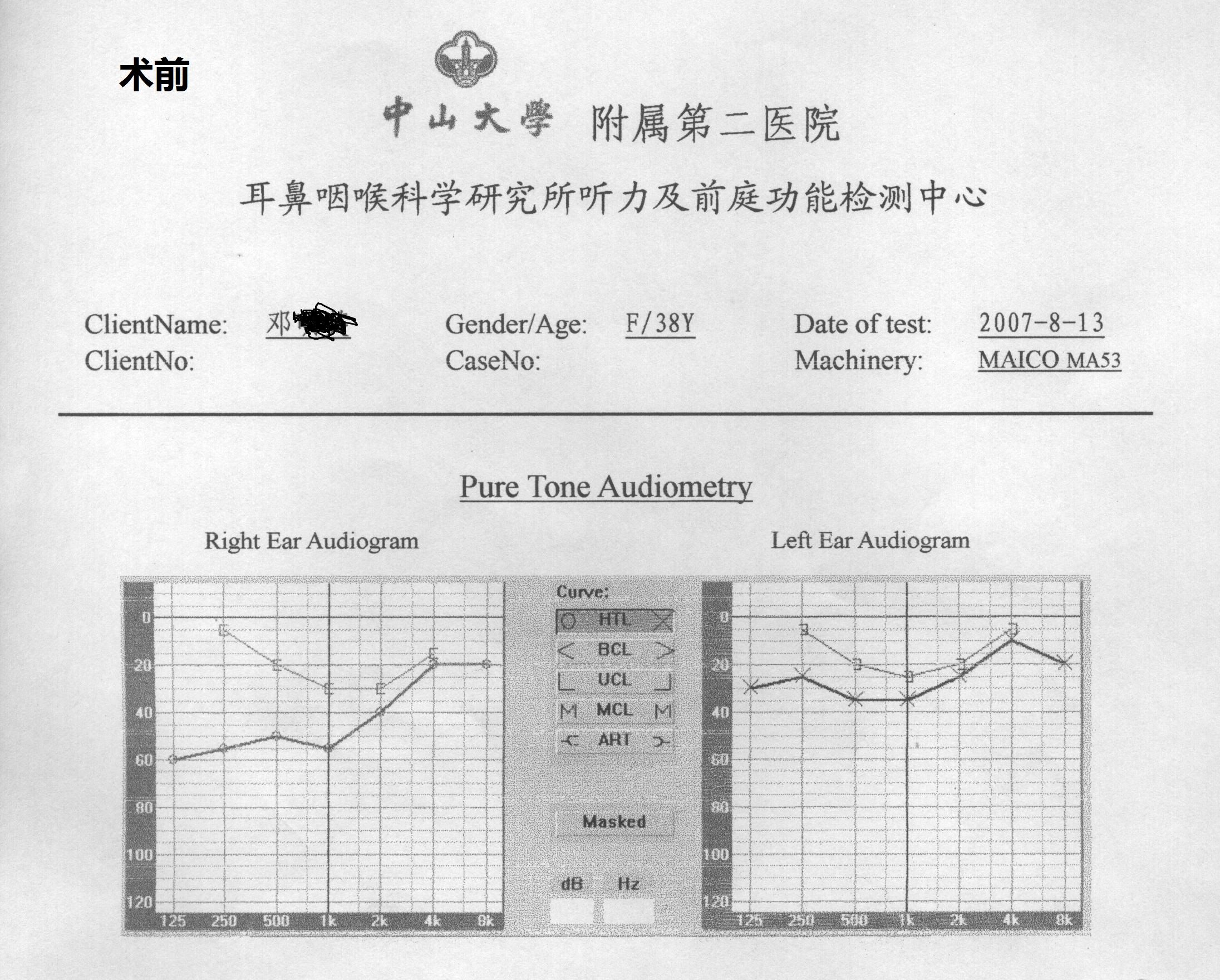 耳硬化症术前术后听力变化