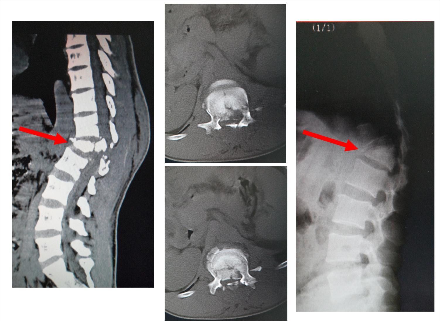 椎体爆裂骨折伴截瘫患者手术治疗