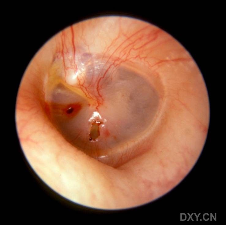 转载外伤性鼓膜穿孔