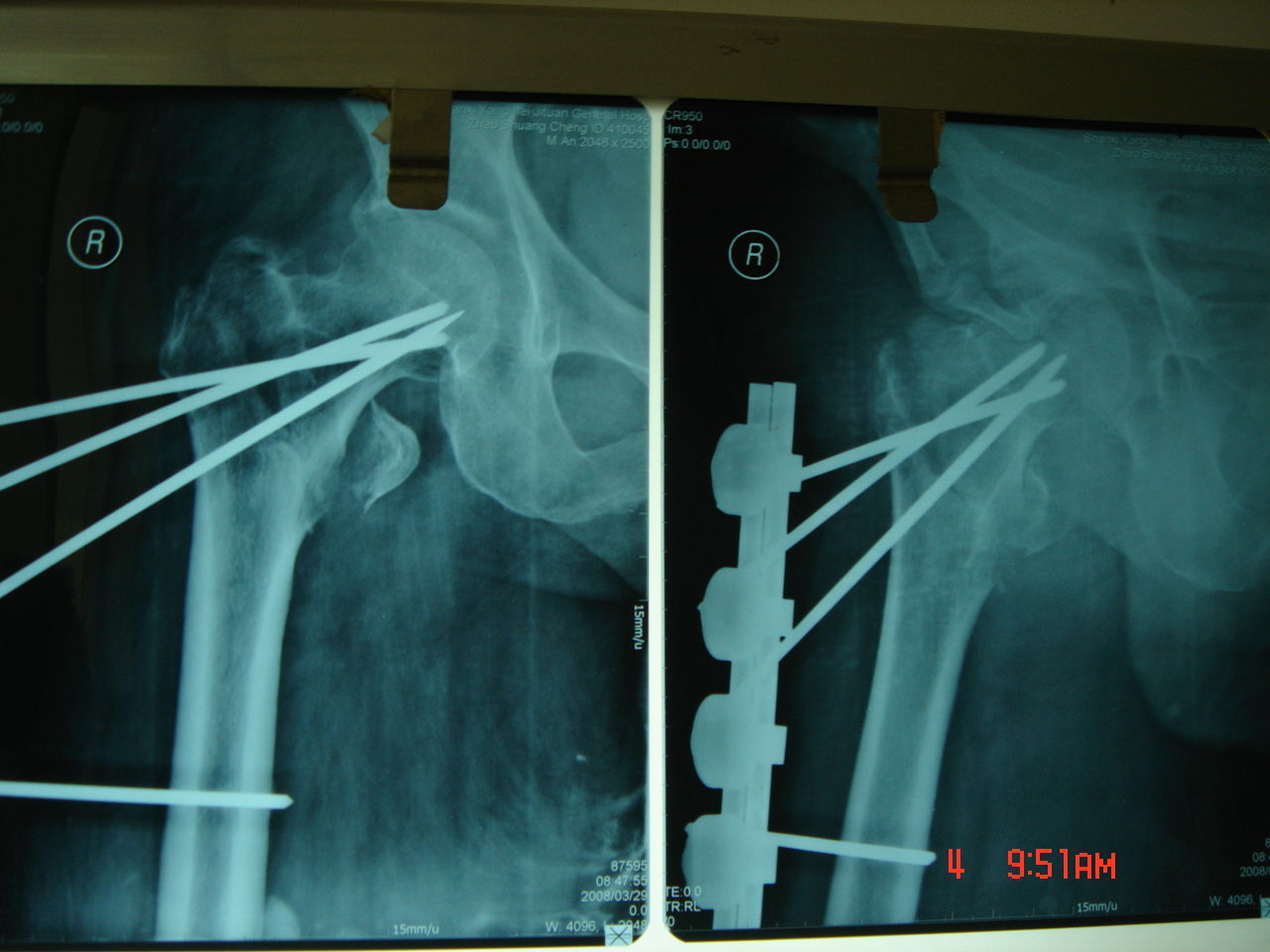 股骨粗隆间骨折的手术治疗_股骨骨折_手术_治疗方式 - 好大夫在线