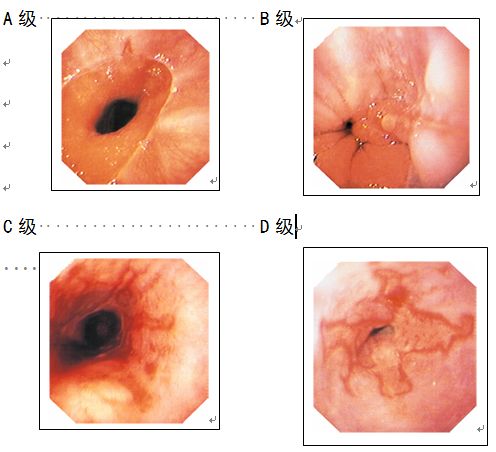 a级食管炎是指食管黏膜的损伤局限于黏膜皱襞, 未融合; 且糜烂的长度