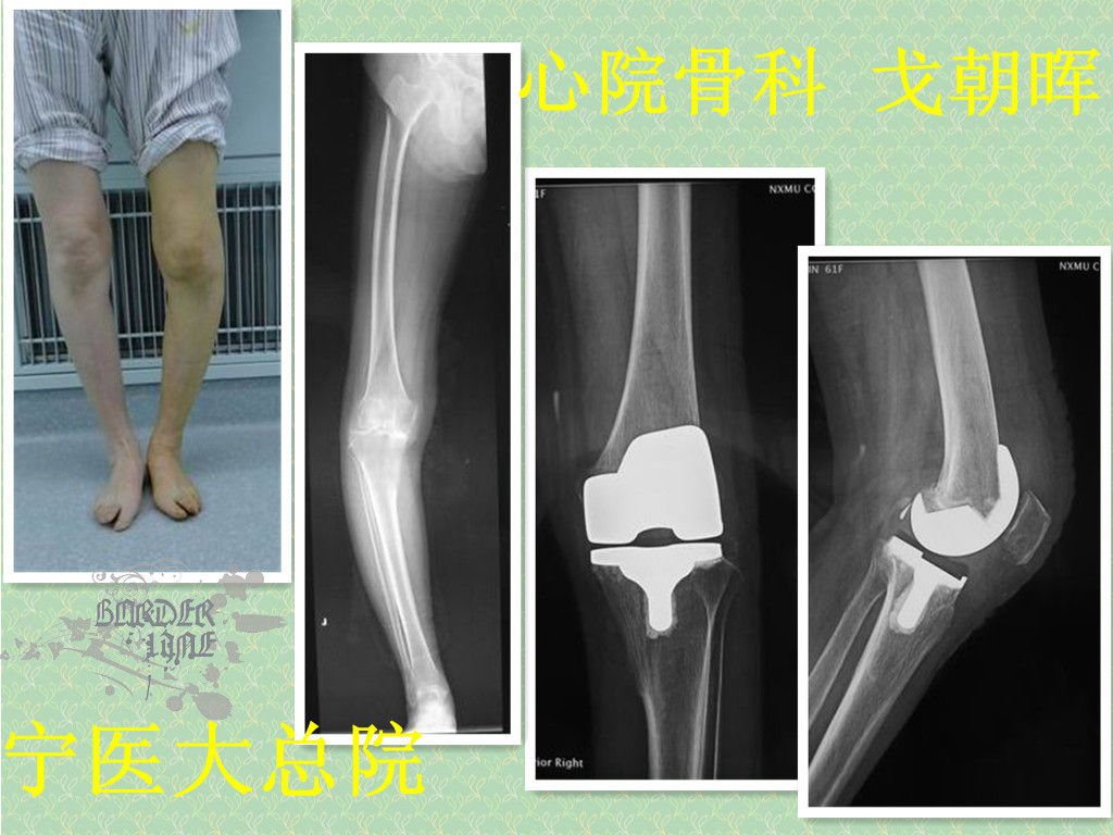 重度膝关节骨性关节炎-人工全膝关节置换-典型病例1