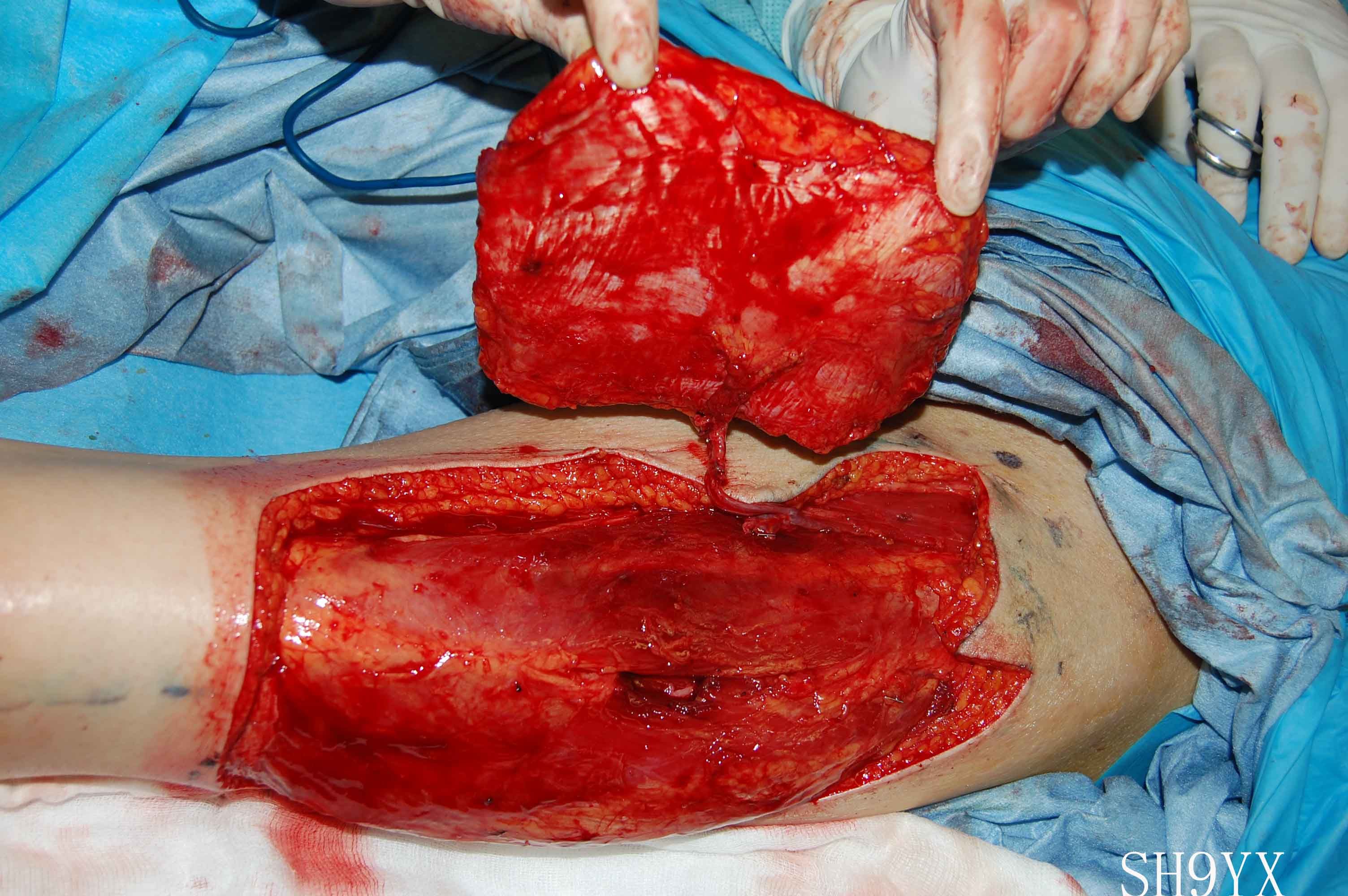 大面积胸骨坏死皮肤组织缺损的手术重建