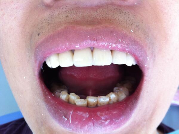 前牙美容上颌4-4 烤瓷单冠治疗氟斑牙