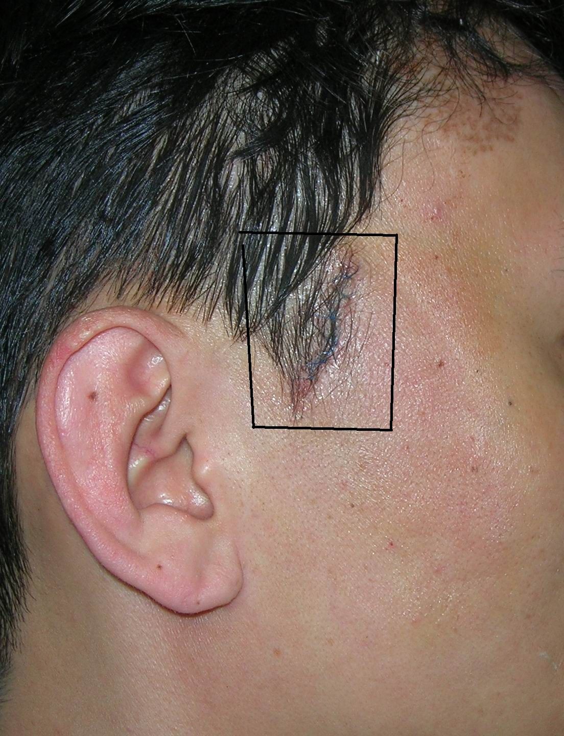 体表良性肿物,尤其是面部,按常规切口容易造成切口永久性 瘢痕