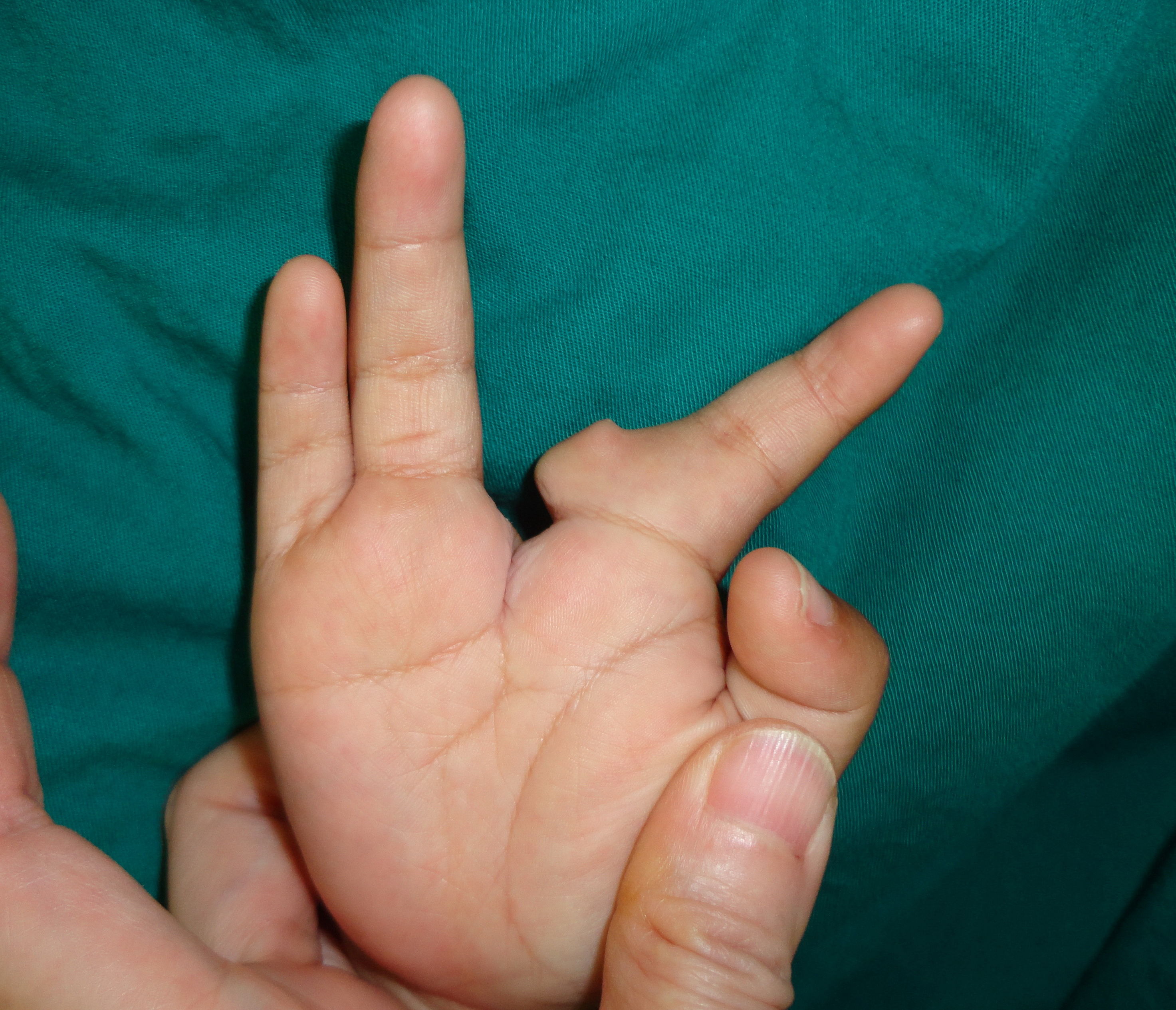 拇指尺偏畸形-三节拇指畸形_多指畸形_介绍_症状表现 - 好大夫在线