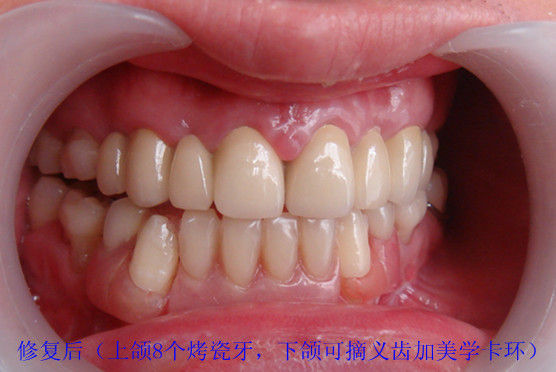病例图片三先天性缺牙修复