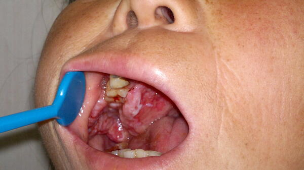 患者,女,56岁,口腔内巨大 肿瘤 已经影响到她的说话及进食.