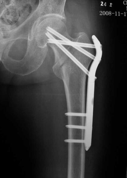 微创锁定加压钢板治疗高龄股骨粗隆间骨折