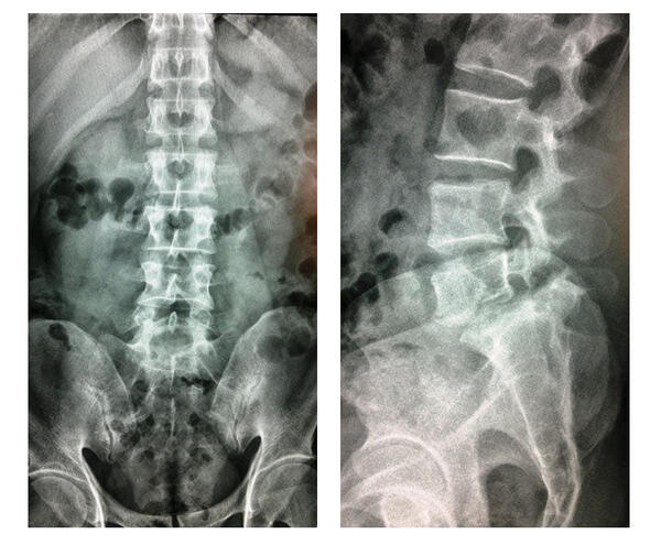 病例1 患者中年男性,常腰部活动工作,致双侧椎弓峡部断裂,腰5骶1滑脱