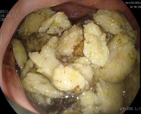 胃石的诊断与治疗