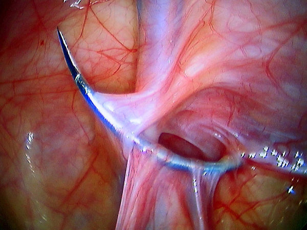 单孔腹腔镜手术(图谱)治疗儿童腹股沟疝和鞘膜
