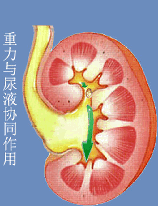 肾结石治疗新方法--体位辅助排石法