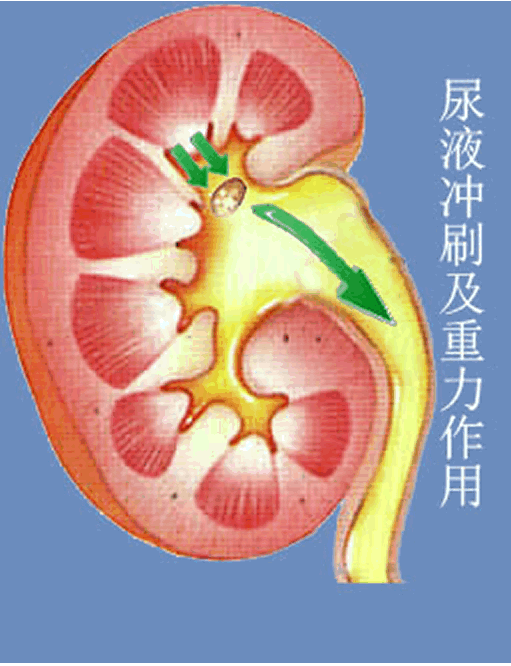 肾结石治疗新方法--体位辅助排石法