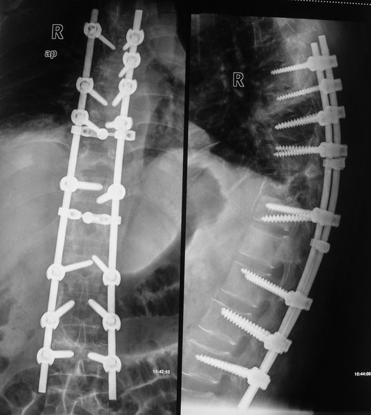 VCR截骨术治疗陈旧性脊柱结核严重后凸畸形