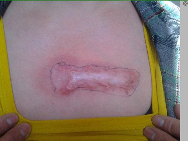 同位素敷贴治疗瘢痕疙瘩典型病例(山东青岛) -