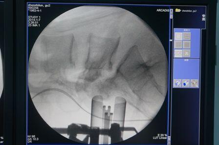 腰5椎弓崩裂伴滑脱病例20141