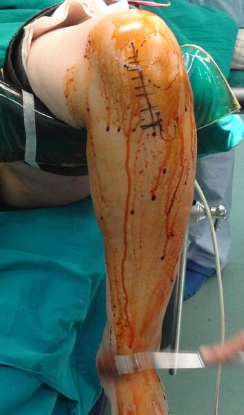 小手术解决膝盖大问题--活动半月板膝关节单髁关节置换术