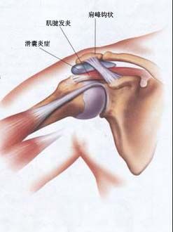 肩峰撞击征的物理治疗-基于力学原理的非手术治疗方法