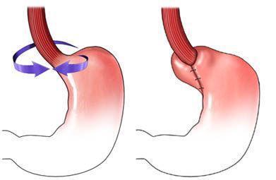 胃食管反流病 可以腹腔镜手术治疗