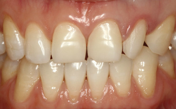 前牙过小牙齿小牙齿畸形患者瓷贴面美学仿真修复