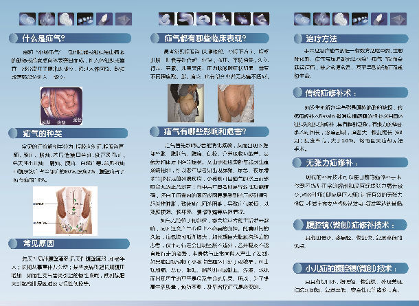 疝气的规范治疗