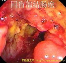 大肠解剖和结肠癌图片 (转载)