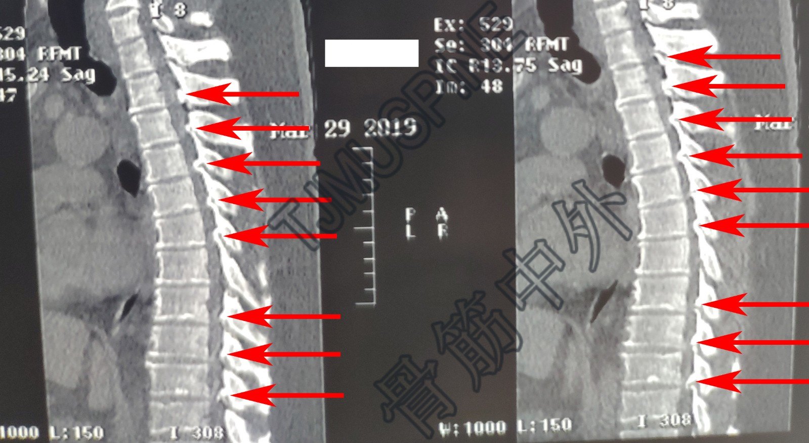 t2/3-t6/7,t8/9-t10/11水平黄韧带增厚,骨化,椎管后部狭窄术前胸椎ct