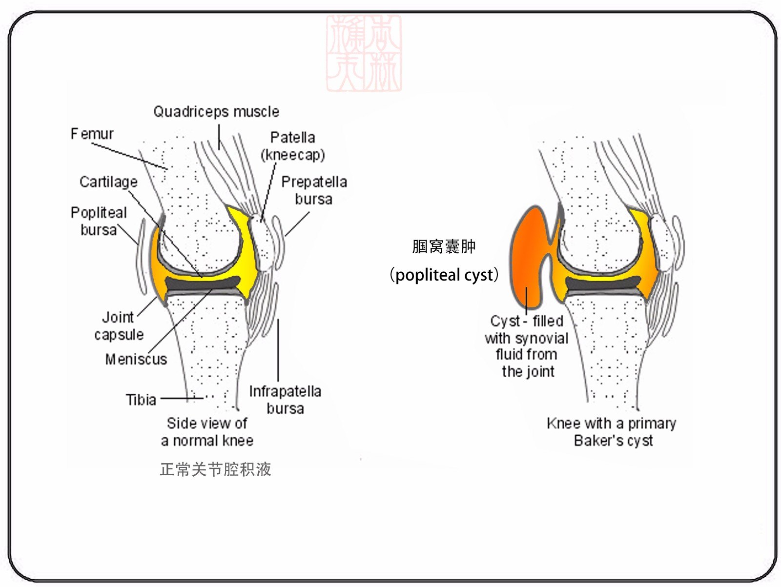 腘窝囊肿的微创治疗含关节镜下手术录像