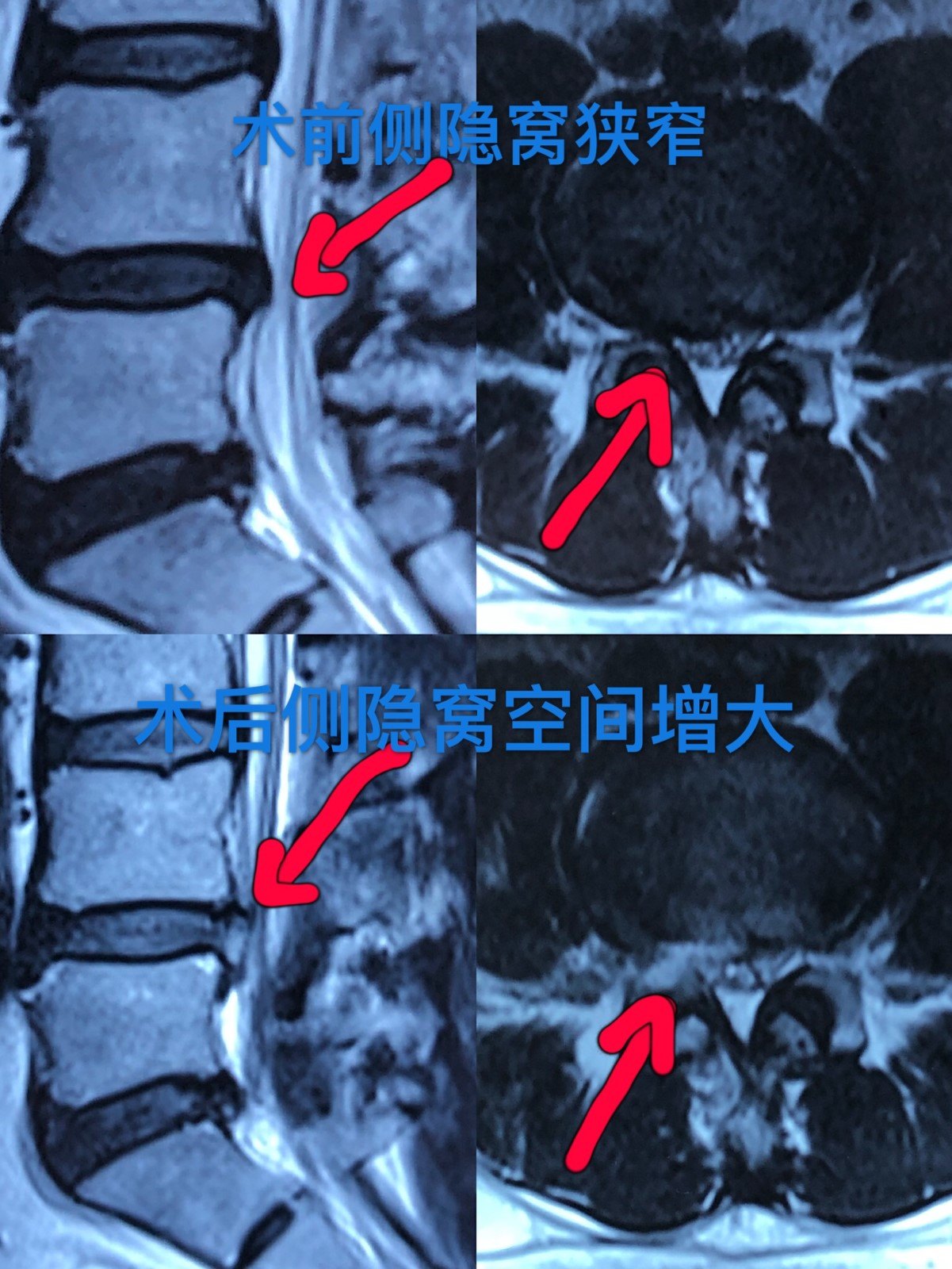 椎间孔镜治疗椎管狭窄效果确切,而且创伤小,恢复快.