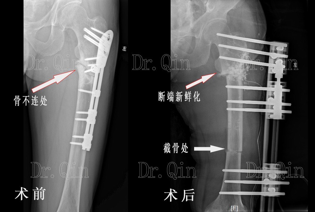 和内固定两种方法各有优势,使用外固定行骨搬运通常无需取髂骨植骨,而