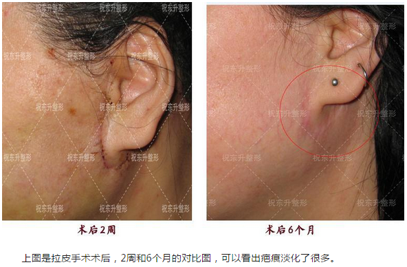 脸上皮肤松垂,想做大拉皮,担心——损失表情?有多疼?疤痕