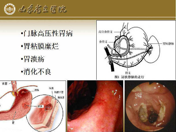 脾切除贲门周围血管离断术