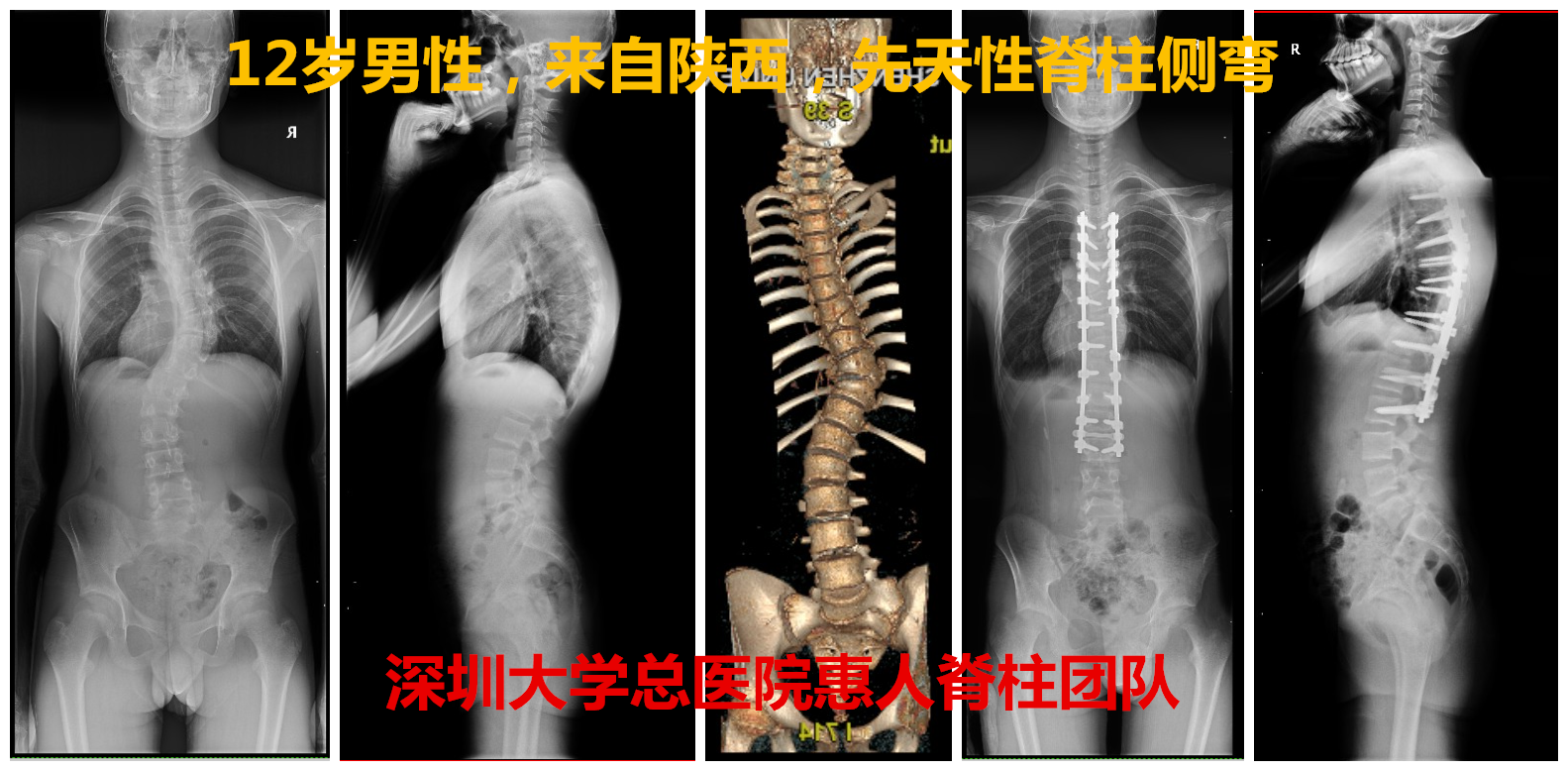 案例青少年脊柱侧弯的手术治疗陶惠人教授手术案例