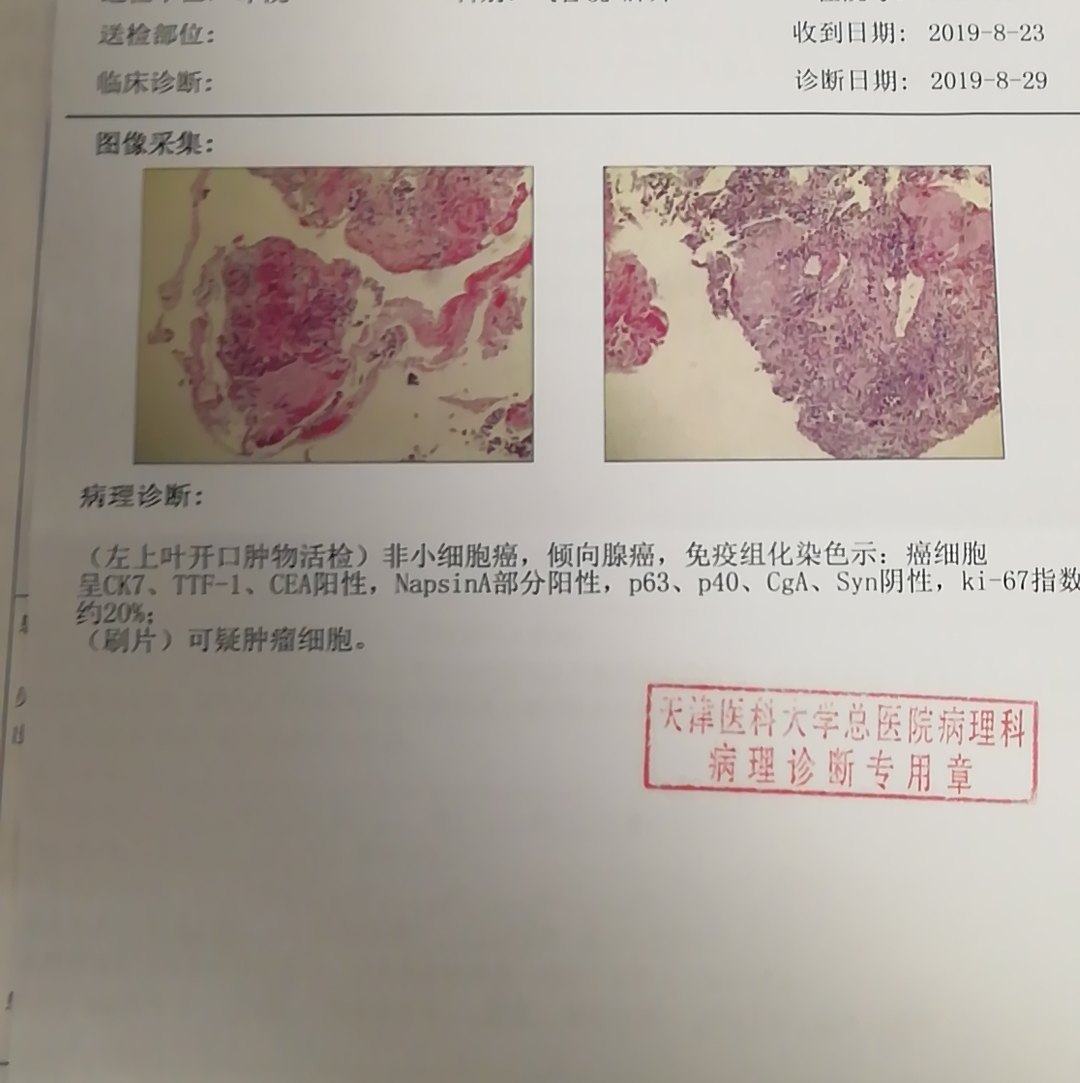 刘懿博士说肺癌(九三九)肺癌做支气管镜,报告有几部分?