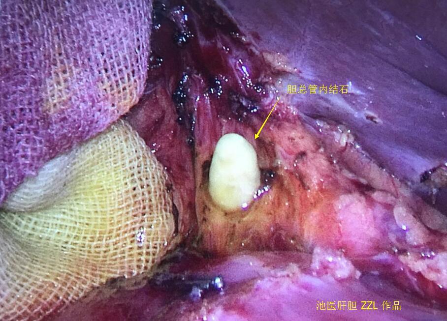 胆总管结石治疗之腹腔镜胆道探查取石胆道一期缝合术