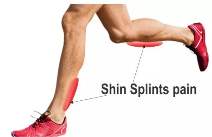 肌腱炎 肌腱是连接肌肉和骨骼的纤维组织.