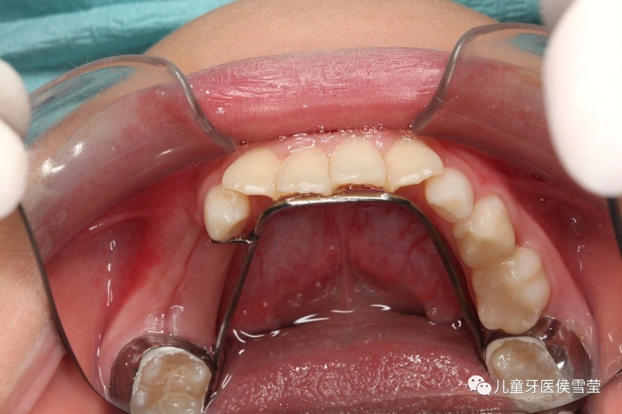 间隙保持器的种类间隙保持器是指儿童牙齿在过早失去后,用于维持正常