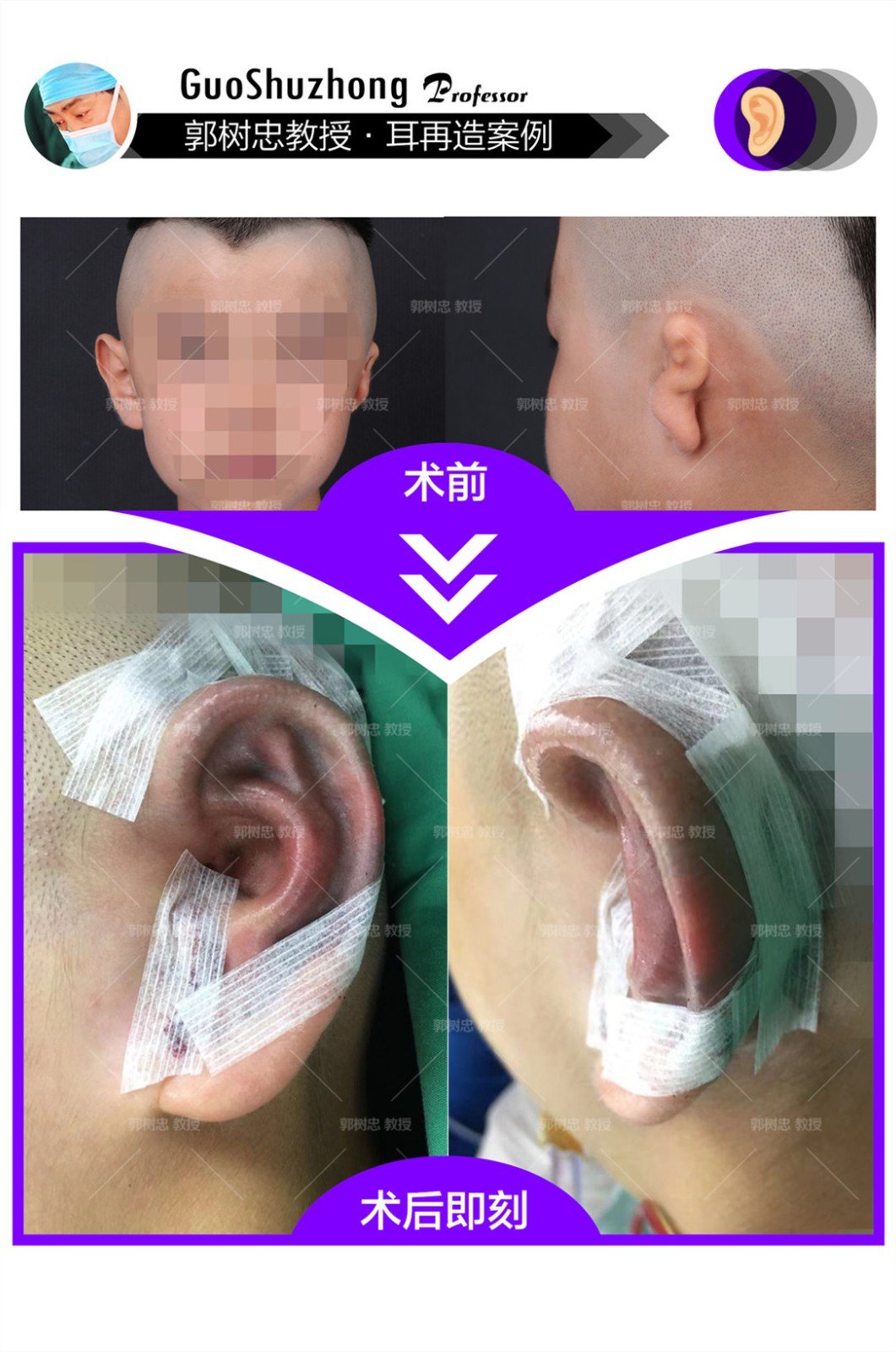 耳朵所在区域的骨头突起叫乳突,乳突的前上方为外耳道,如果天生有外耳