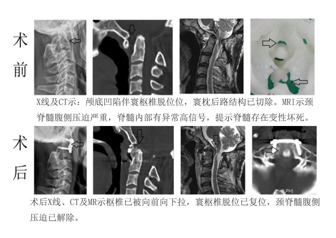 颅底凹陷后路手术失败行走困难,经口前路翻修恢复正常