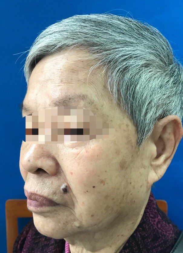 以为是美人痣,其实是皮肤癌