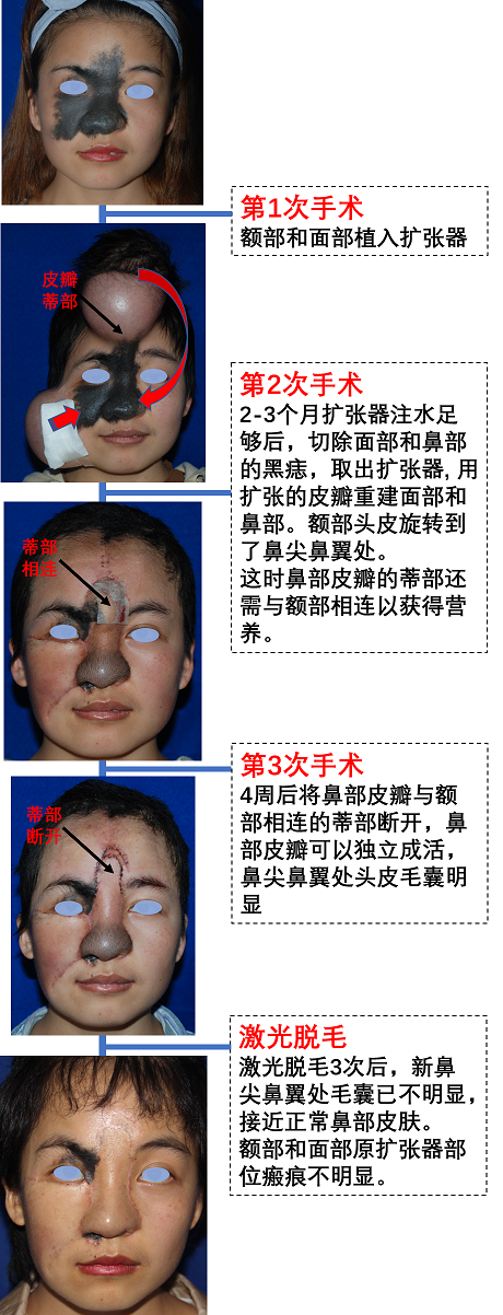 面部和额部扩张后用皮瓣修复面部和鼻部巨痣实例图