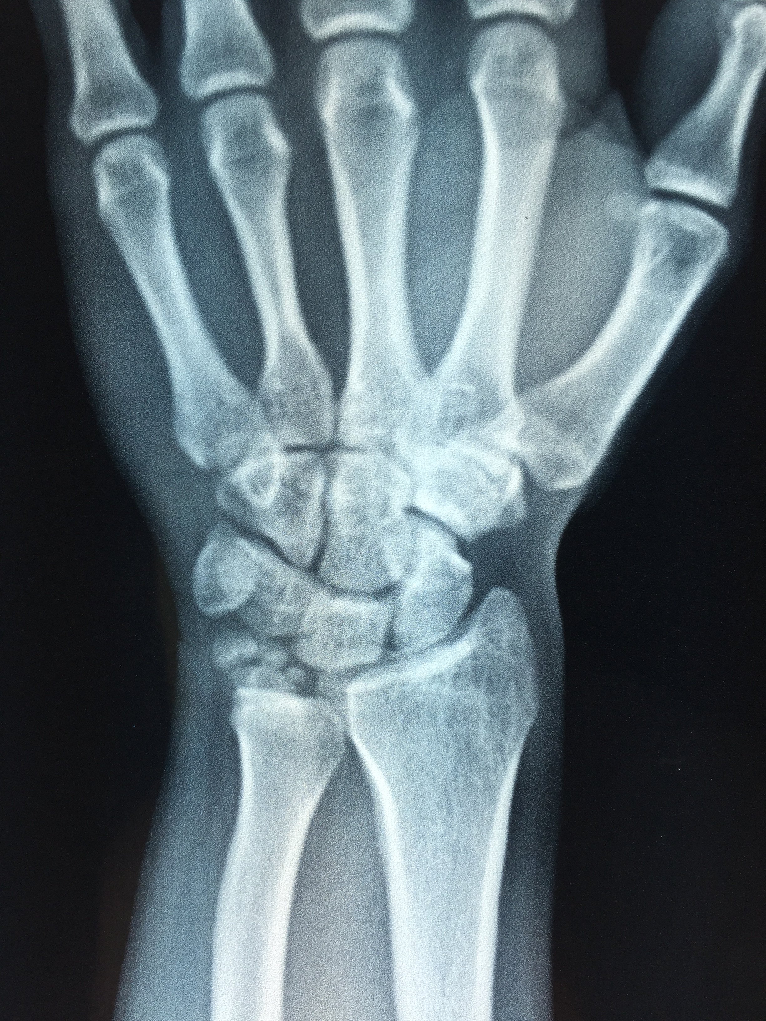 腕关节三角软骨损伤如何治疗? (原创)
