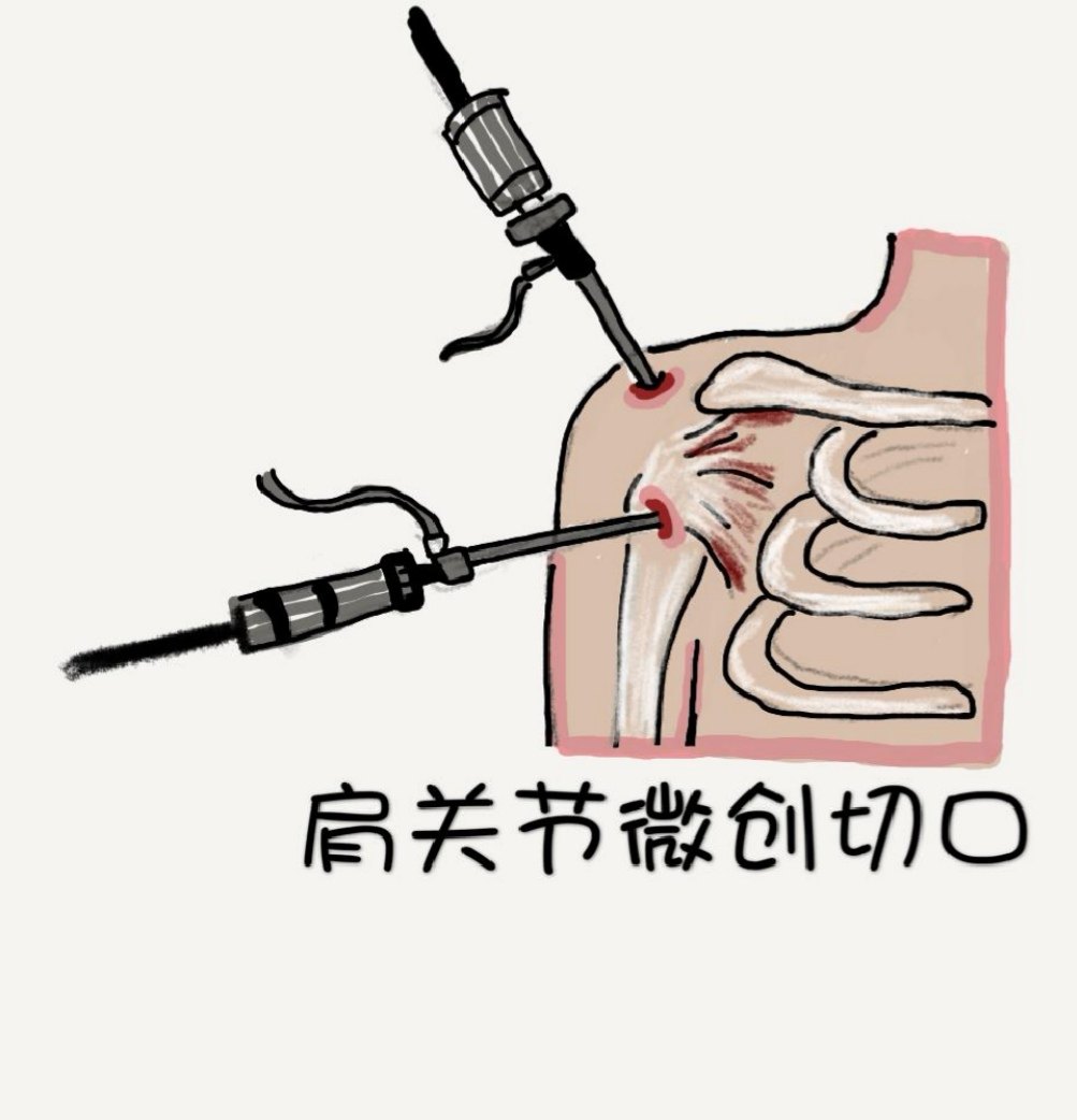 肩痛科普知识系列问答34肩袖损伤的手术大不大需要多长时间