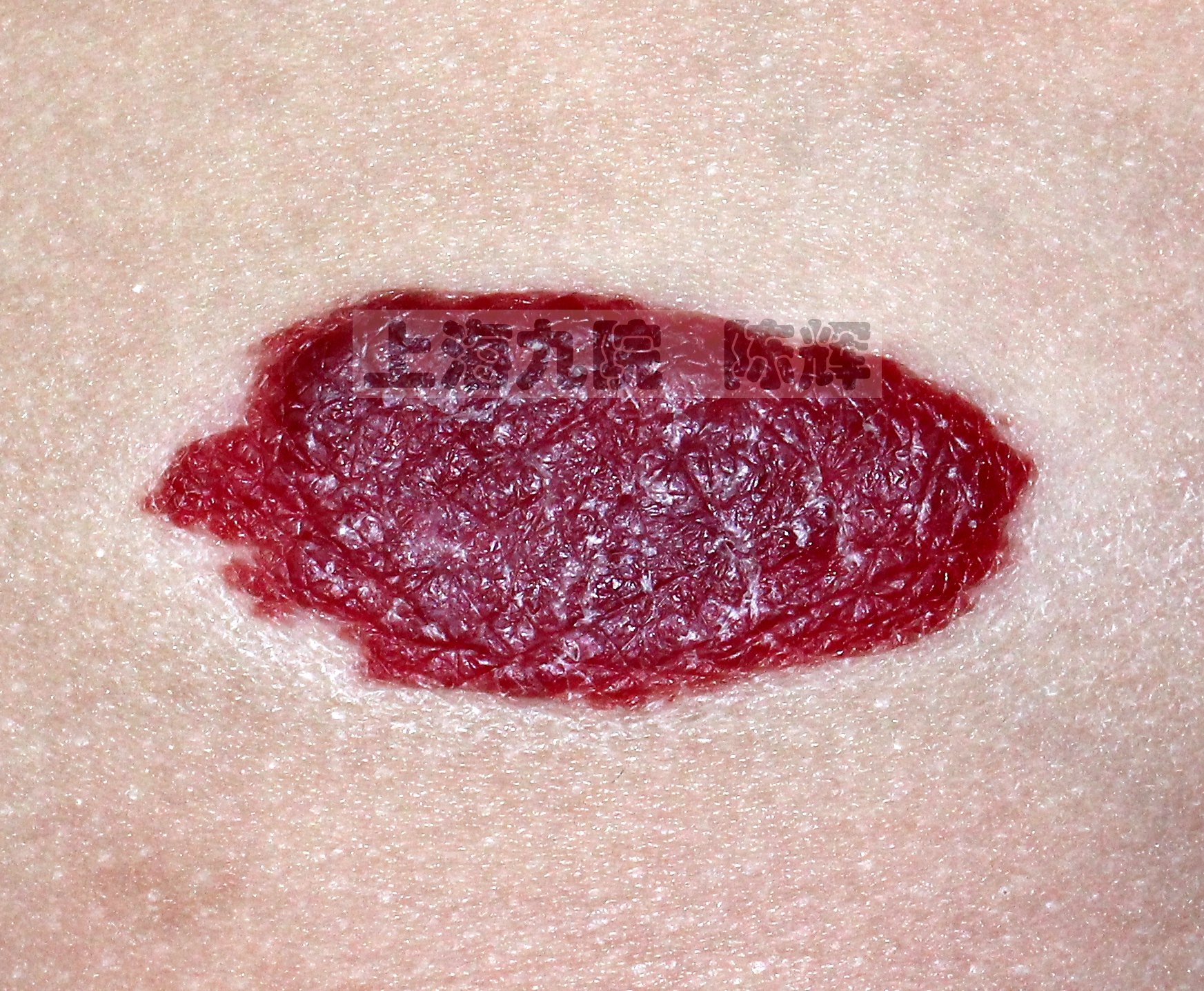胸部增生期血管瘤.鲜红色,血泡感更加明显,皮肤纹理清晰可见.