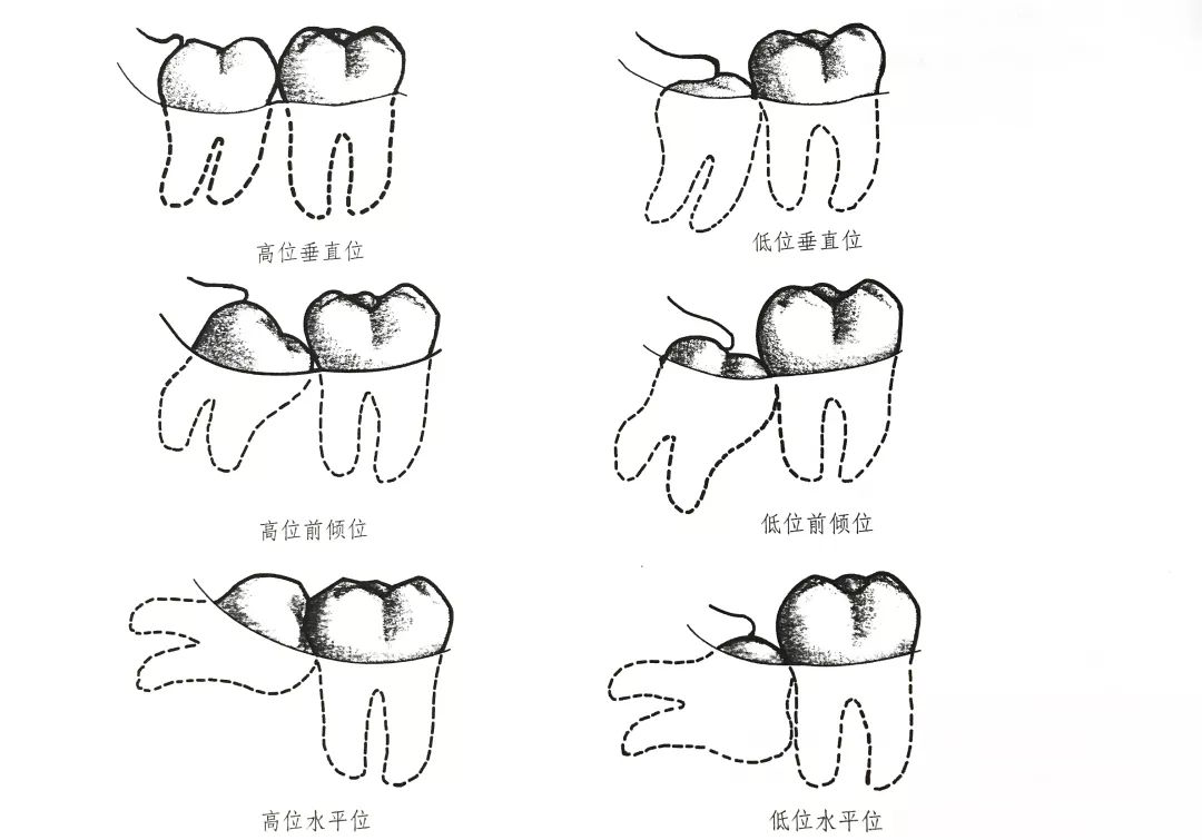 鉴于阻生智齿各种高难度的销魂姿势,微创拔牙前需要拍 x 线片才能看清