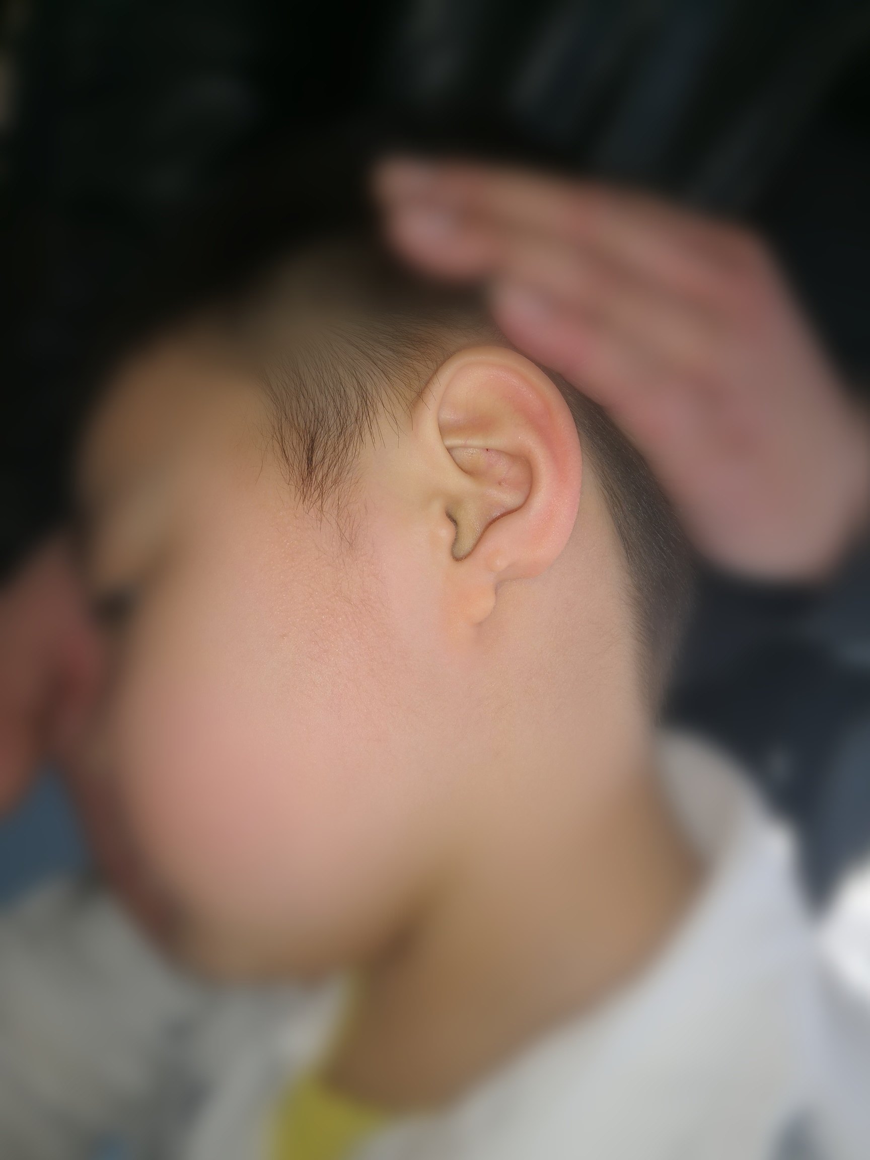 耳垂缺如的修复案例