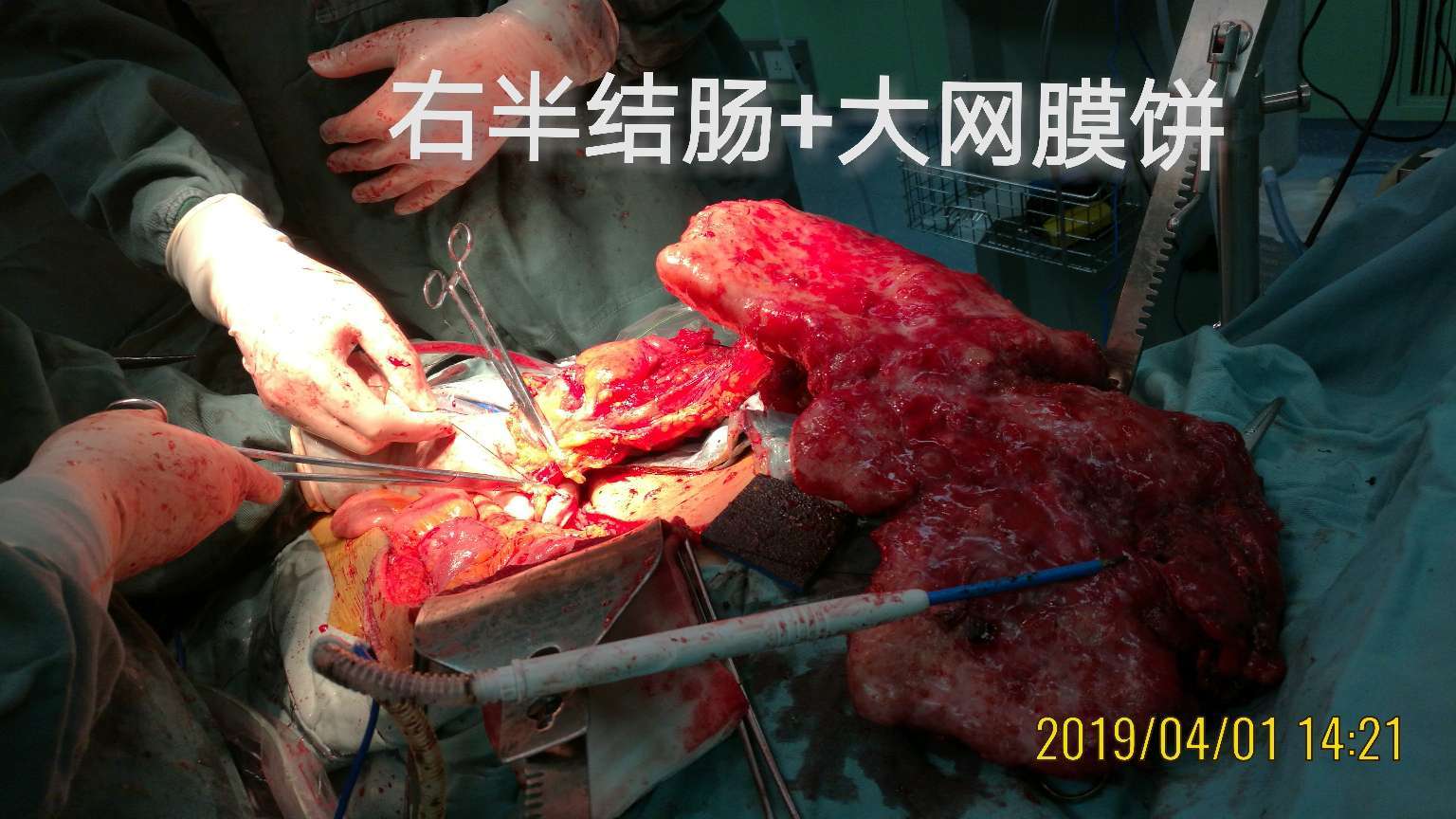 病例34腹水查因提示阑尾恶性肿瘤腹腔转移